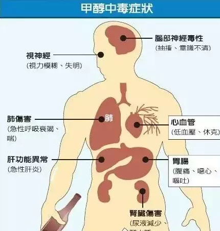 甲醇后期中毒症状